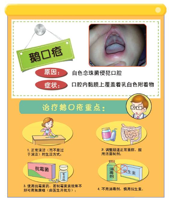 (图片信息重要,点击放大观看更清晰) 出现鹅口疮,说明婴儿消化道正常