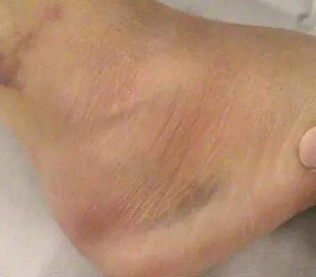 软组织肿胀 搜狐网