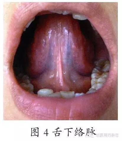 舌脉正常图片大全图片