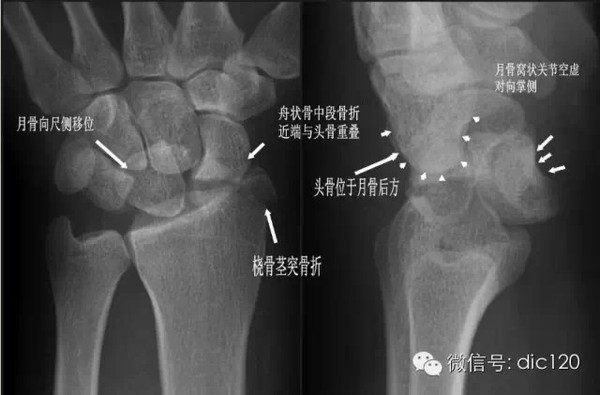 【診斷要點】 ①尺骨或橈骨莖突骨折;②舟狀骨中段骨折,近端與頭骨