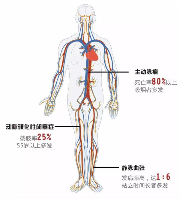 血管是怎样惹上麻烦的认识动脉粥样硬化