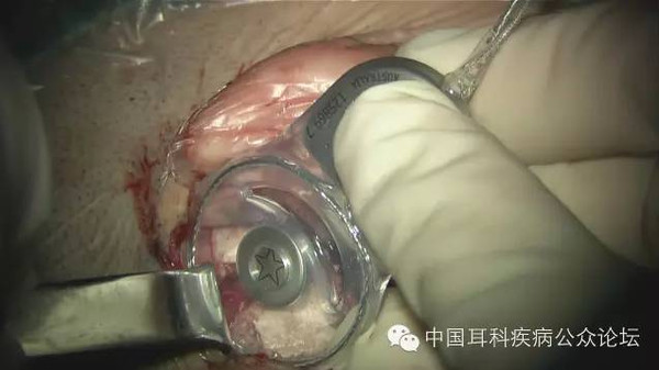 电子耳蜗植入术图片