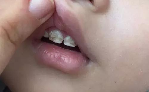 小孩牙齿矿化图片图片