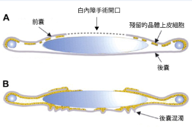 白内障手术后如何处理后发障