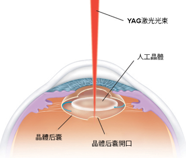 后发性白内障图片