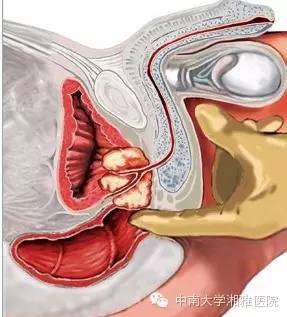 指检前列腺感觉要弯了图片