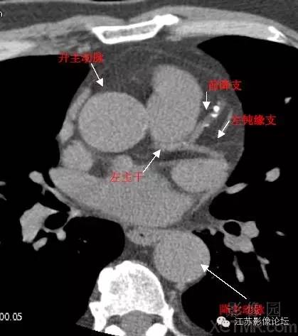 带你全面了解心脏冠状动脉ct解剖
