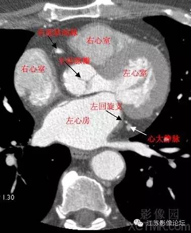 髂动脉CT解剖图图片