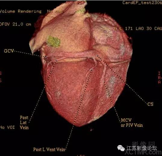心臟冠狀動脈ct解剖中文詳細標註(圖文)