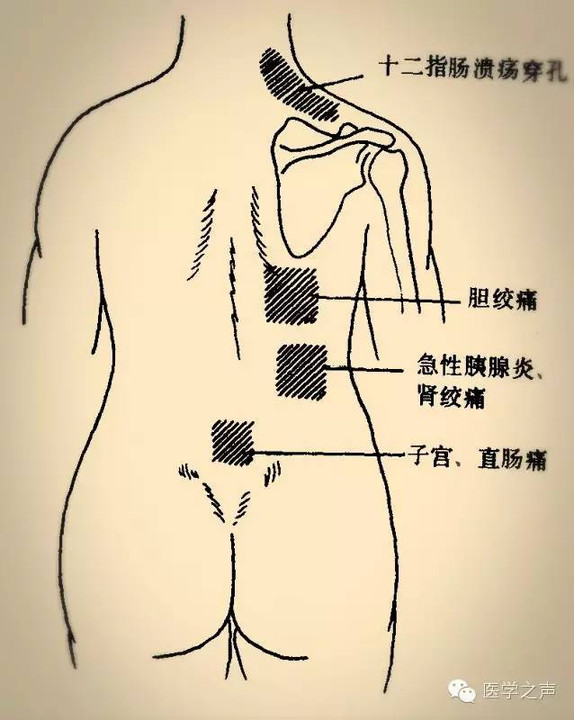 图解:常见腹痛的放射区!