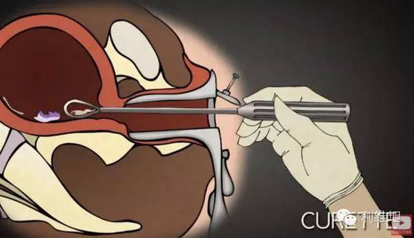一个医生的堕胎图解