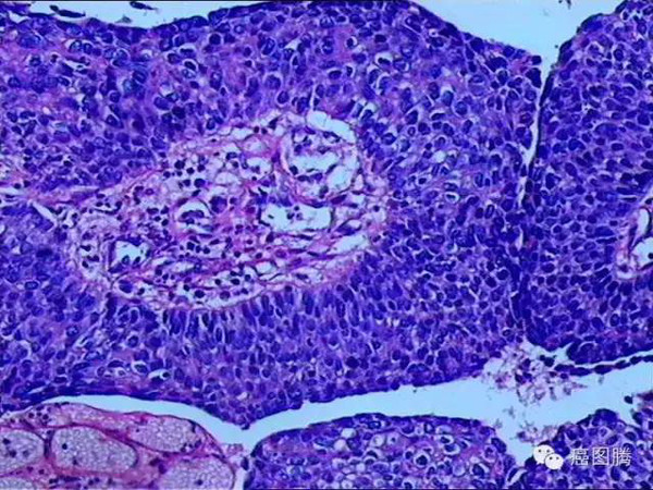 局部組織細胞增生可形成的呈佔位性塊狀突起,也稱贅生物(neoplasm)