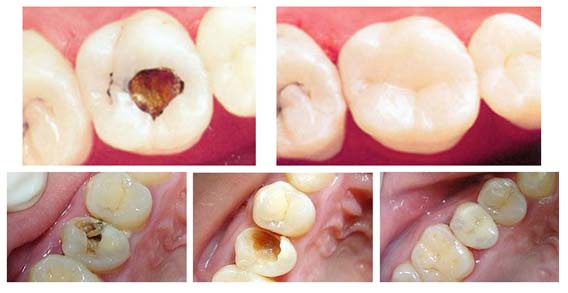 龋齿充填是将可塑性材料充填入窝洞内,以恢复牙齿外形和功能的过程