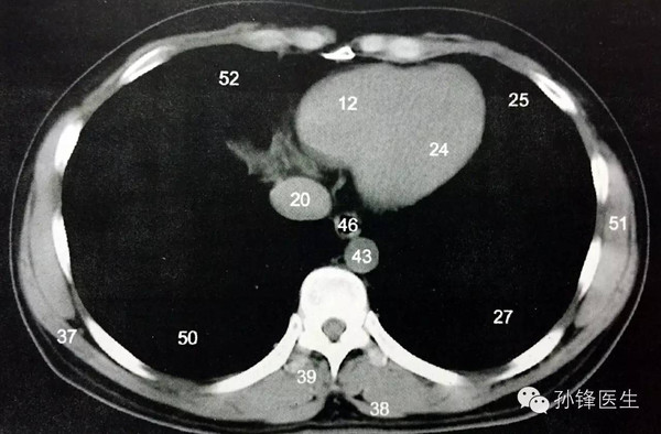 图腹部人体断层解剖经冠状窦的横断层