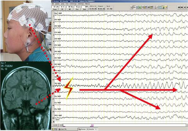 脑电图报告单图片