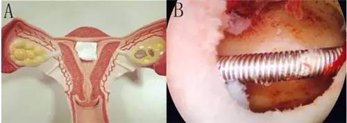 宫腔支架取出过程图片图片