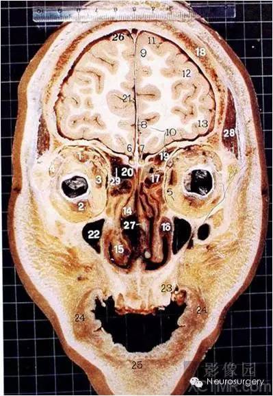 水平位颅脑断层解剖来啦,冠状位还会远吗?