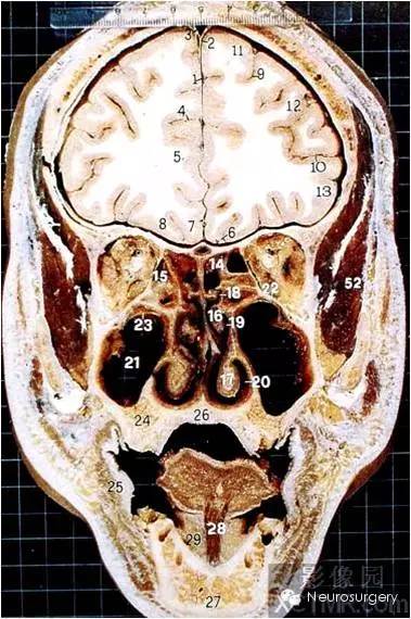 水平位颅脑断层解剖来啦冠状位还会远吗