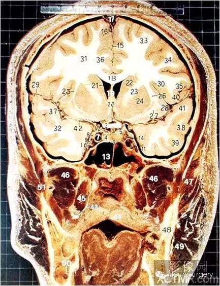 头颅冠状位图解图片