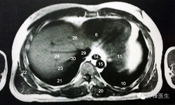 第二肝门ct图片