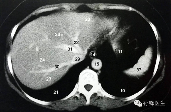 (图)腹部人体断层解剖:经第二肝门的横断层