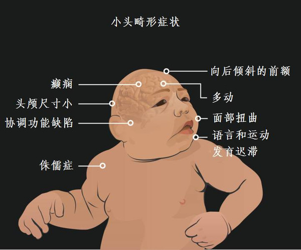 小头症婴儿的症状表现图片