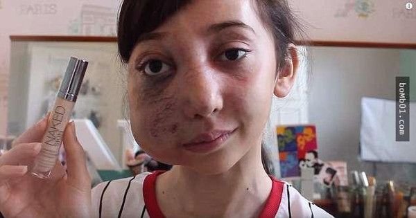 6岁时罹患罕见病致半边脸畸形,但她的事让人感动