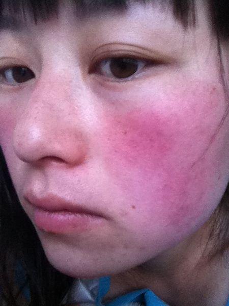 长痘痘发红怎么办?