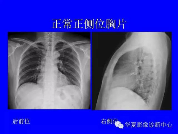 胸部平片怎麼讀規範報告怎麼寫