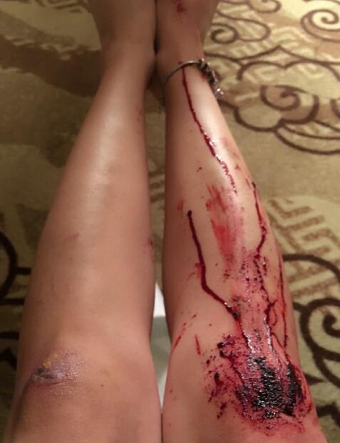 女生小腿划伤流血图片图片