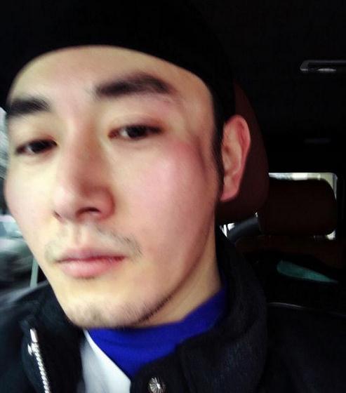李东学脸部受伤