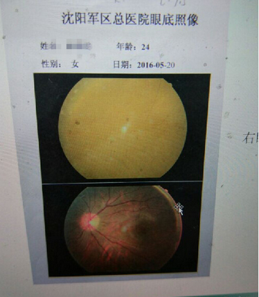 图上方为小晴眼底的图像,明显已被玻尿酸几乎全部覆盖,这也是导致其视力严重受损的原因。