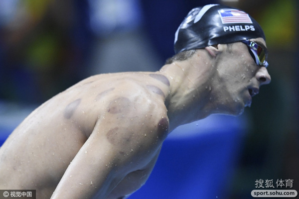 2016奥运游泳对手   北京时间8月10日,菲尔普斯现在几乎是拔罐治疗