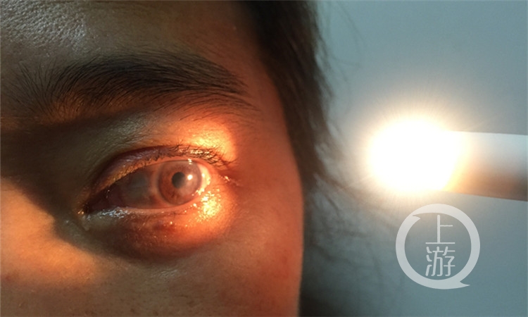 原标题:40岁女子移植猪眼角膜 视力大部分可恢复