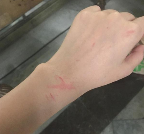 照片中鞠婧祎手腕多处红肿受伤,网友们纷纷表示希望她一定要小心,