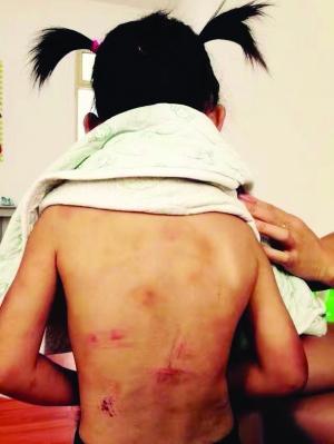 镇江疑遭家暴女童母亲部分伤痕为奶奶管教造成