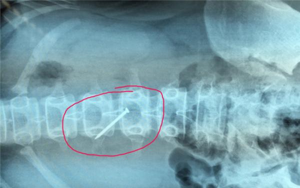 江苏淮安13岁女孩吞下4厘米长铁钉,疑遭同学欺负被逼吞下