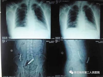 景德镇第二医院拍摄的X光片显示，査澄华腹中有9枚钢钉