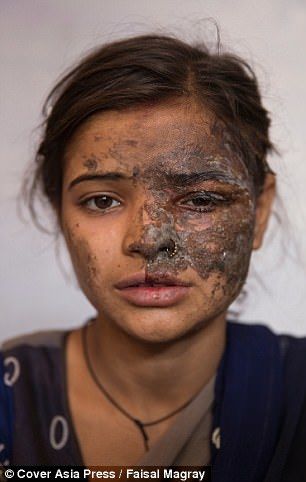 印度女孩被父亲泼硫酸毁容只因举报爸爸买卖妇女